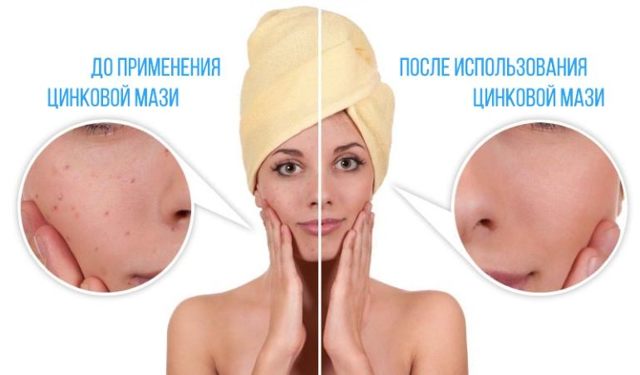 Цинковая мазь цена от 16 руб, Цинковая мазь купить в Москве, инструкция по применению, аналоги, отзывы