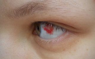 От чего лопаются сосуды в глазах: причины и лечение