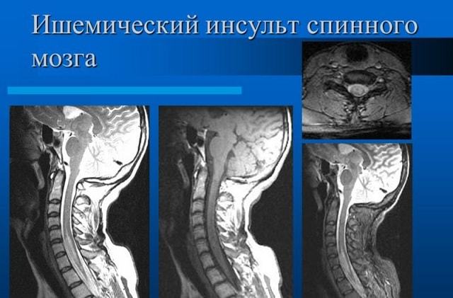 Инсульт спинного мозга (спинальный): симптомы, лечение, последствия