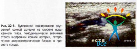 Передняя ишемическая нейропатия
