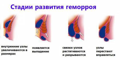 Свечи от геморроя и трещин прямой кишки