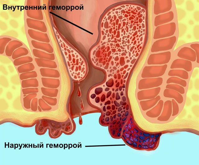 Геморрой - виды, стадии, причины, симптомы, лечение