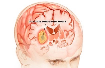 Единичные очаги в белом веществе головного мозга - результаты МРТ