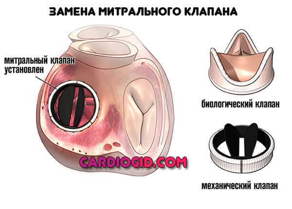 ПМК 1 степени - симптомы, лечение, диагностика