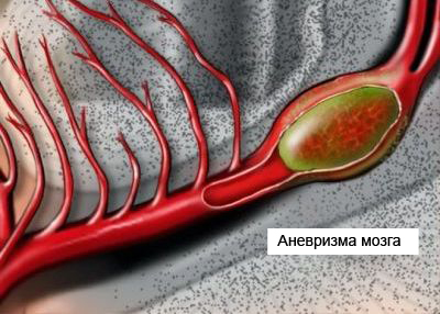 Клипирование аневризмы артерий головного мозга