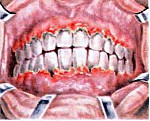 Острый, язвенно-некротический гингивит Венсана: лечение, симптомы и диагностика