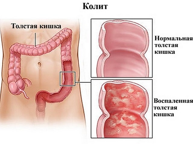Токсичность традиционно используемых слабительных средств