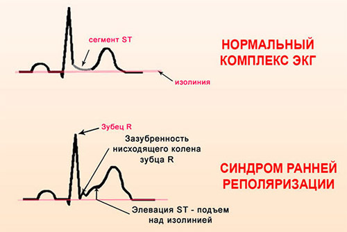 Синдром ранней реполяризации желудочков (СРРЖ)