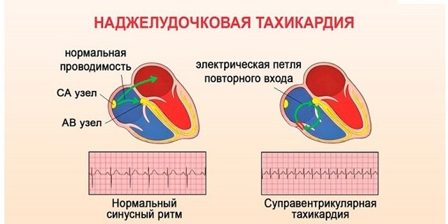 Тахикардия сердца: симптомы, диагностика и лечение - DELFI