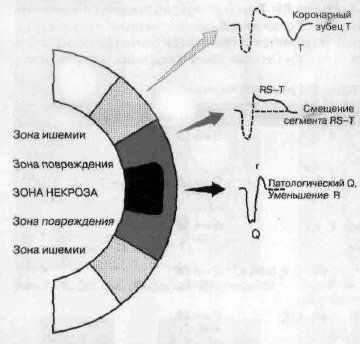 Инфаркт миокарда на ЭКГ: признаки, расшифровка