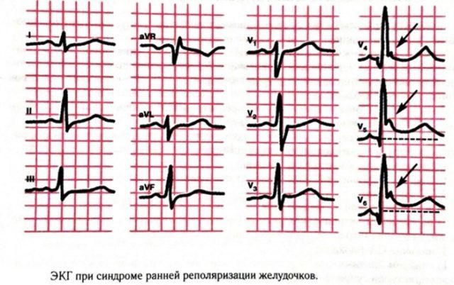 Нарушение процессов реполяризации в миокарде