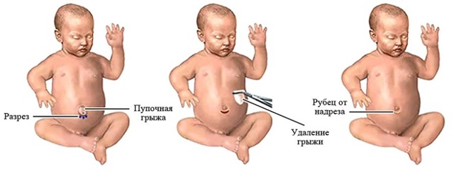 Пупочная грыжа у детей: фото, лечение и симптомы у детей