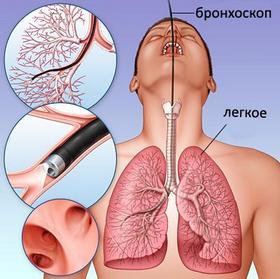 Кашель с кровью – кровохарканье.