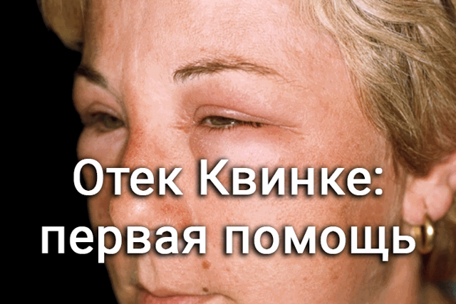 Отек Квинке симптомы и лечение в домашних условиях народными средствами