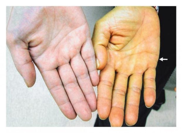 Как понизить билирубин в крови: лекарства и народные рецепты