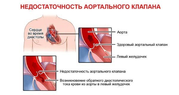 Аортальный порок сердца: симптомы и лечение