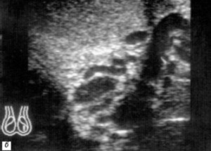 Видео операции варикоцеле яичка: процесс и исход