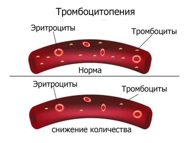 Тромбоцитопения - что это такое, причины возникновения, симптомы и лечение у детей и беременных
