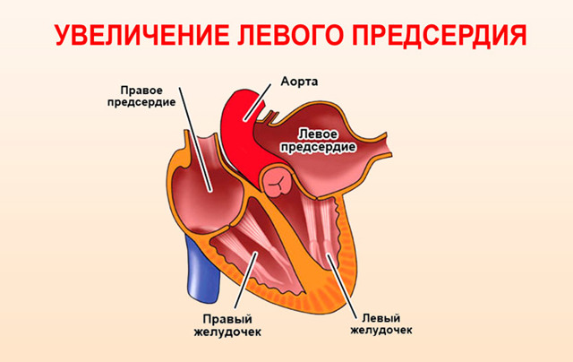 Гипертрофия левого предсердия что это такое - Всё о сердце