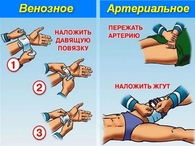 Первая помощь при кровотечениях