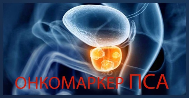 Анализ крови ПСА — что это такое? Расшифровка и норма