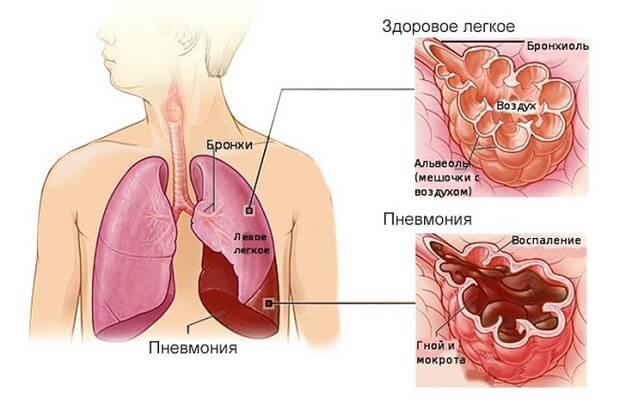 Симптомы пневмонии у взрослого человека: признаки без температуры, первое воспаление легких, вирусная, лечение