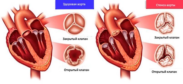 Стеноз аорты: симптомы и медикаментозное лечение