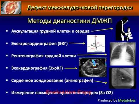 Гипертрофия межжелудочковой перегородки - опасно ли?