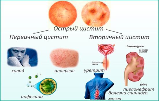 Какой врач лечит цистит у женщин, детей и мужчин
