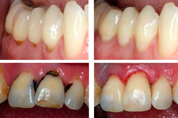 Пришеечный кариес - причины, симптомы, диагностика и лечение