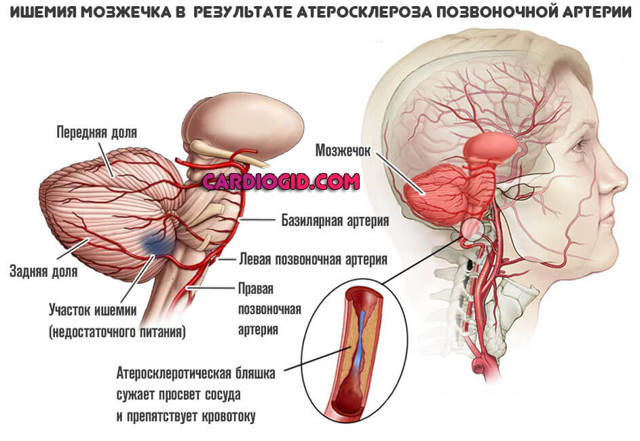 Атеросклероз сосудов головного мозга - лечение, симптомы
