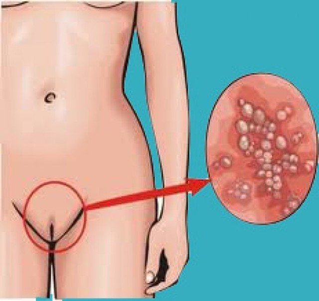 Вульвит у женщин – симптомы и лечение, фото