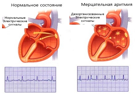 Мерцательная аритмия: причины, симптомы и лечение
