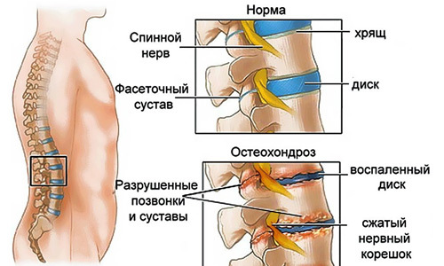 Что делать, если беспокоит жжение в области сердца