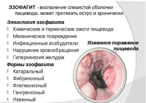 Боль в грудине: причины болевых ощущений слева, справа и посередине грудной клетки (видео)