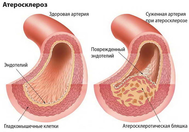 Инсульт левая или правая сторона, последствия, сколько живут
