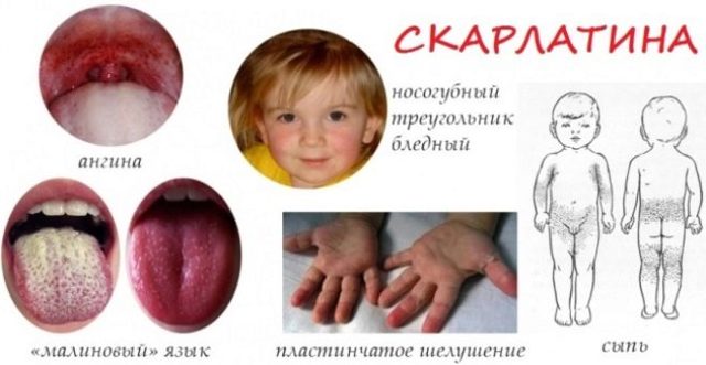 Скарлатина у детей - фото, симптомы и лечение, профилактика