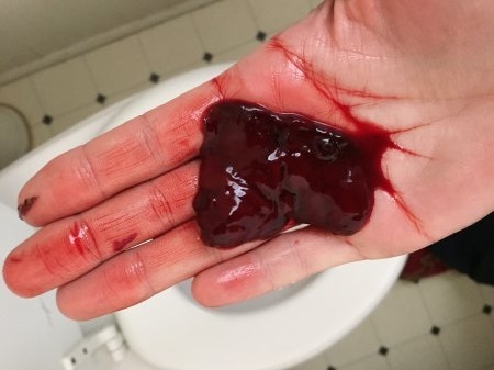 Месячные идут со сгустками крови и кусками — причины