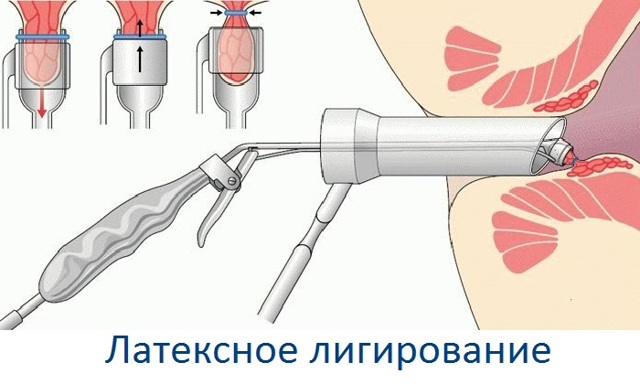 Хронический геморрой – лечение хронического геморроя, симптомы и признаки