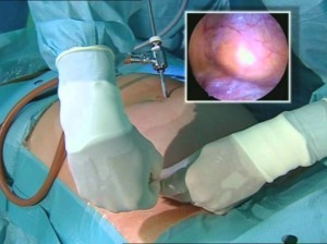 Видео операции варикоцеле яичка: процесс и исход