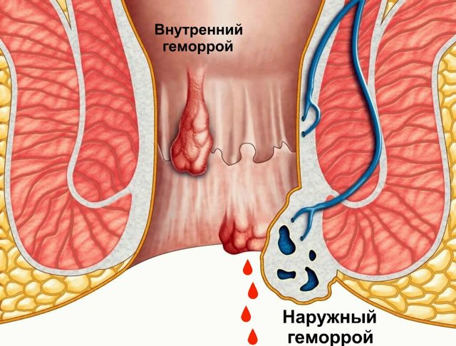 Кровотечение из заднего прохода без боли при стуле: причины и лечение