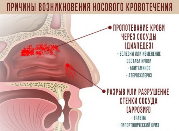 Кровь из носа — из-за чего часто идет, если пошла во сне, причины носового кровотечения у детей, течет по утрам, при сморкании, постоянно, каждый день, что это значит