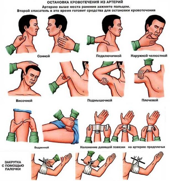 Виды кровотечений и оказание первой помощи