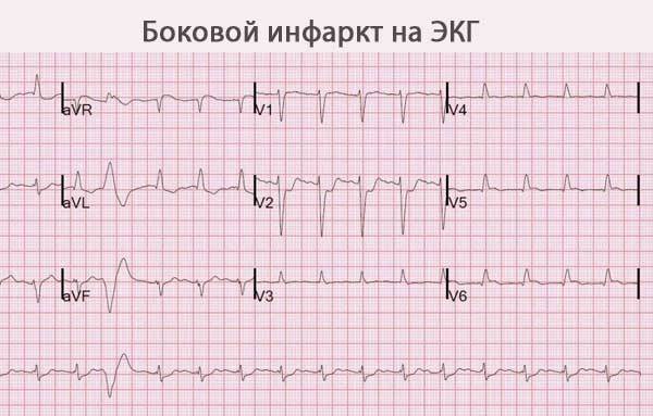 Инфаркт миокарда на ЭКГ: признаки, расшифровка