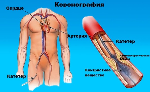 Коронарография сосудов сердца
