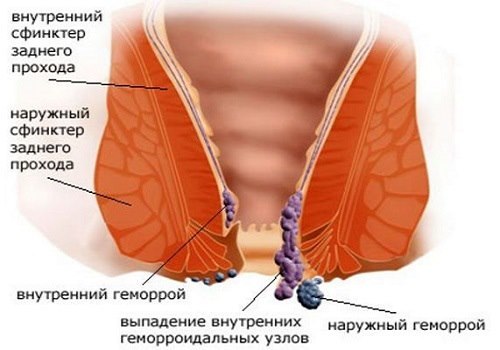 Чешется ли геморрой - Геморрой