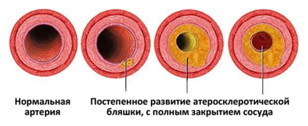 Диабетическая ангиопатия нижних конечностей: лечение сосудов при сахарном диабете, симптомы