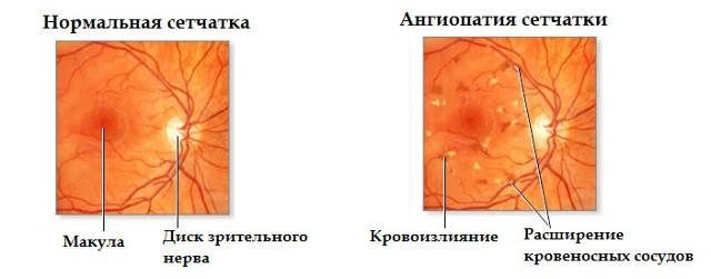 Ангиопатия сетчатки мкб код 10. Что такое ангиопатия сетчатки глаза, и какой код болезни по мкб 10,