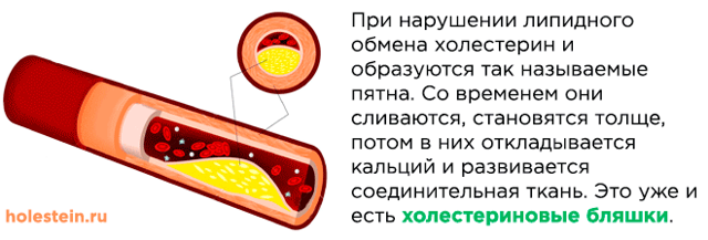 В сосудах бляшки: диагностика и терапия