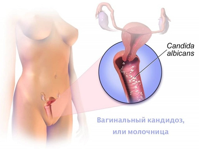 Свечи от молочницы для женщин: обзор недорогих и эффективных препаратов для беременных и не только